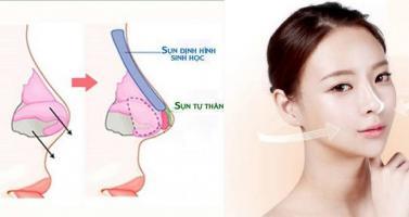 Địa chỉ nâng mũi đẹp và an toàn nhất tỉnh Bình Thuận