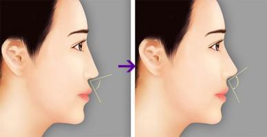 Địa chỉ nâng mũi đẹp và an toàn nhất tỉnh Quảng Nam