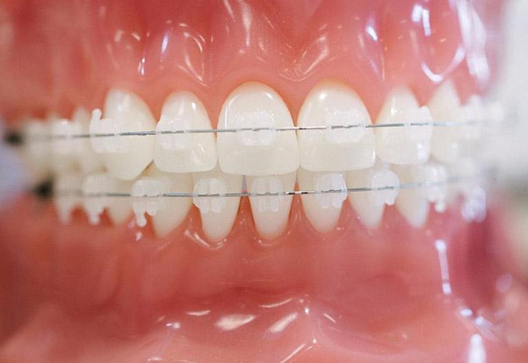 Chi phí niềng răng mắc cài sứ dây trong