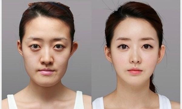 Phẫu thuật thẩm mỹ tại Hàn Quốc