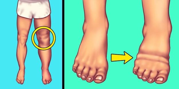 Ăn nhiều muối quá sẽ khiến một số bộ phận của cơ thể sưng tấy