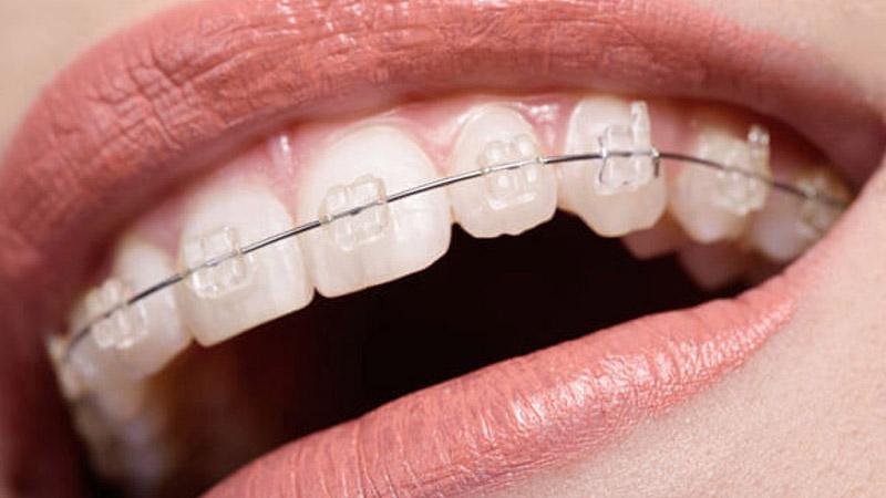 Thời gian niềng răng mắc cài sứ dây trong