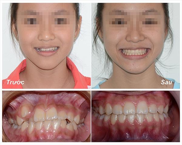 Thời gian niềng răng mắc cài sứ dây trong