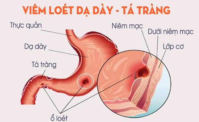 Loét dạ dày - tá tràng là tổn thương tới lớp cơ niêm