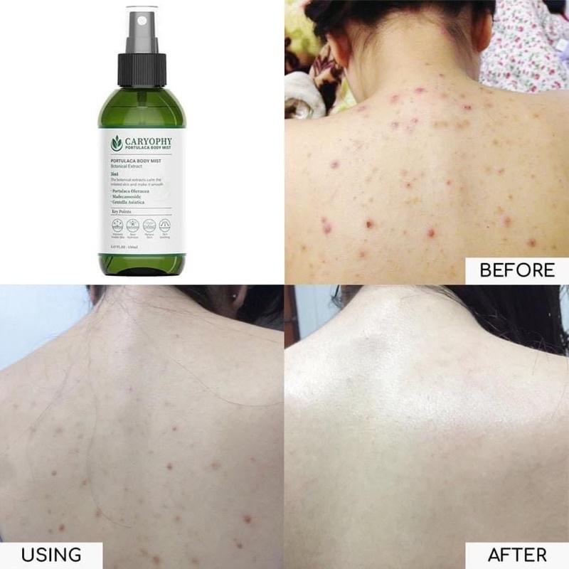 Caryophy Portulaca Body Mist giúp trị mụn lưng hiệu quả, mang lại cho bạn cảm giác tự tin